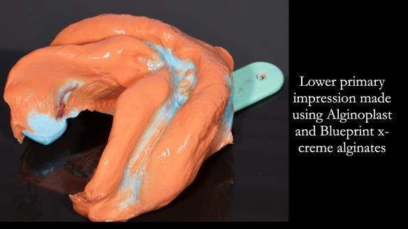 Newsletter 82 Mary - A complete upper and a one-tooth gasket denture