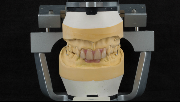 Figure 20 Mounted working cast with Mk 1 immediate dentures. Figure 23 Finished upper and lower immediate dentures. Schottlander Enigmalife teeth