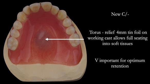 Solving Linda’s Failed “All on 4” implant bridges - full protocol Newsletter 42