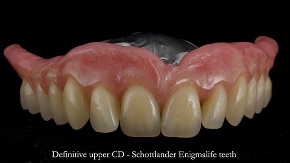 Newsletter 82 Mary - A complete upper and a one-tooth gasket denture