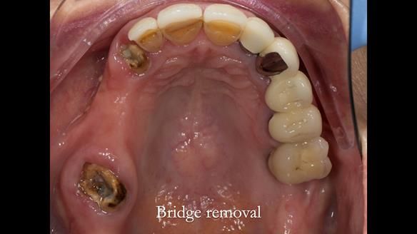 Newsletter 51 Managing Anne’s failing dentition with distal extension base RPD/Splint FULL PROTOCOL