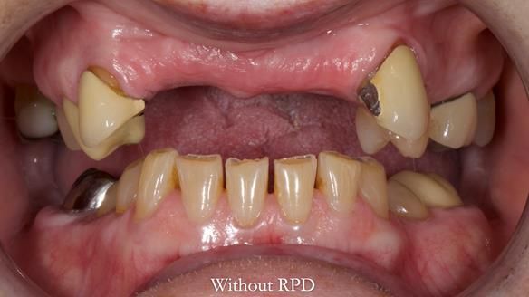 Newsletter 81 - Pam’s Story — how a partial denture changed her life (+ live walkthrough this Thursday)