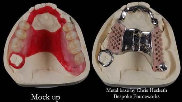 Finlay's Newsletter 60 Sylvia's upper Kennedy Class 2 Mod 1 metal based upper RPD