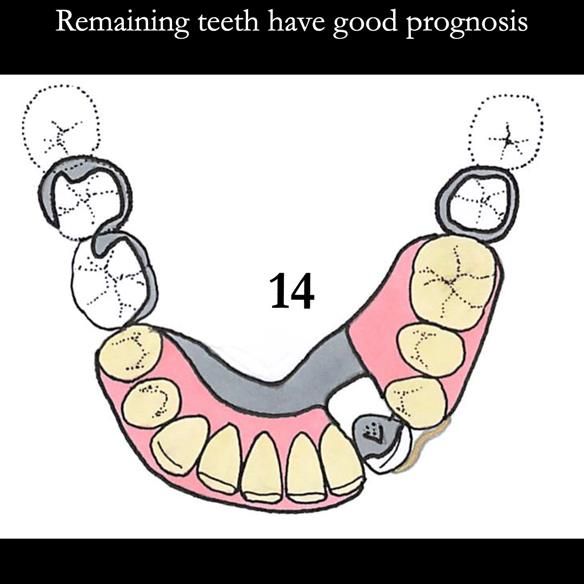 Universal Scandinavian partial denture designs