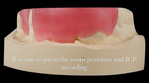 Eileen's transformation with upper and lower RPDs of Scandinavian hygienic design FULL PROTOCOL