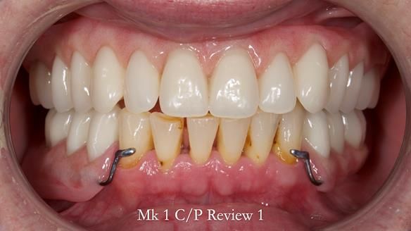 Newsletter 52 Managing Jo’s failing dentition with extractions and Mk 1/Mk 2 complete upper dentures and lower partial dentures FULL PROTOCOL