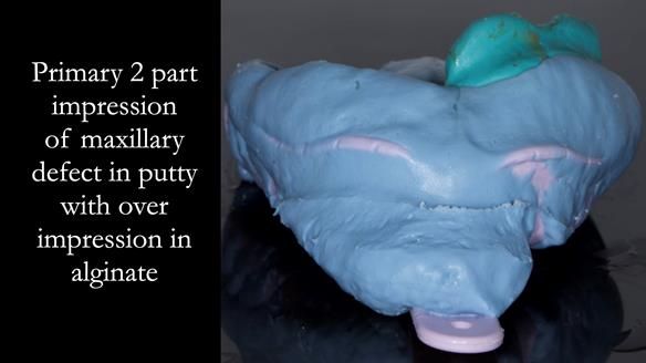 Upper metal base partial denture/occlusal stabilisation splint/obturator - full protocol