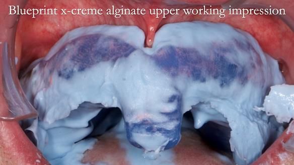 Newsletter 78: What do Clark Gable and a Locator® overdenture have in common?