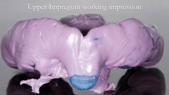 Newsletter 57 showcases the making and fitting process of implant-supported complete dentures for Alisdair