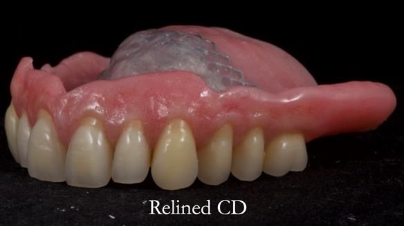 Finlay's Newsletter 62 provision of extractions and metal based complete dentures for Rafique