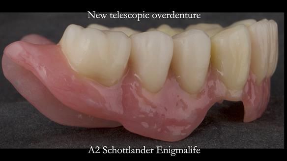 Newsletter 76: Jackie’s case – Telescopic overdenture & precision RPD (the tricky truth!)