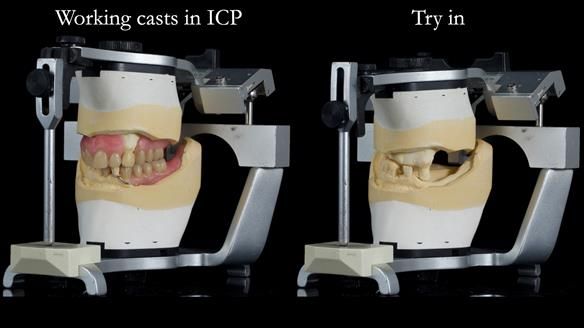 Newsletter 55 Provision of metal based partial dentures for Zephyrine with a repaired cleft lip and palate