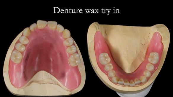 Newsletter 57 showcases the making and fitting process of implant-supported complete dentures for Alisdair