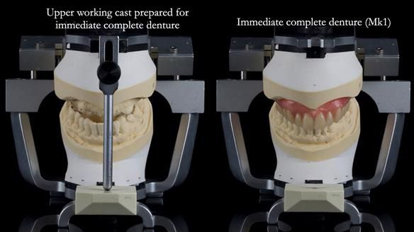 Newsletter 77: Jeremy’s case – immediate complete upper denture