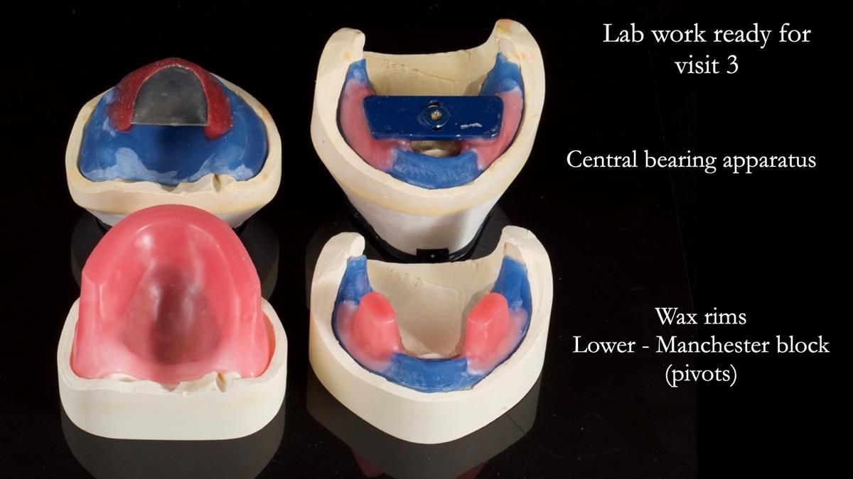 Fin’s Newsletter 88 — Complete dentures - full protocol… he rearranged his own teeth!
