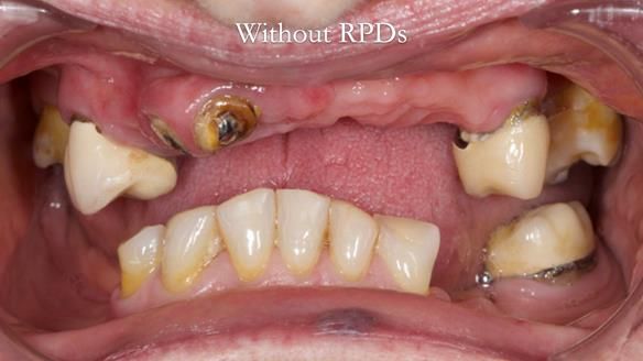 Eileen's transformation with upper and lower RPDs of Scandinavian hygienic design FULL PROTOCOL