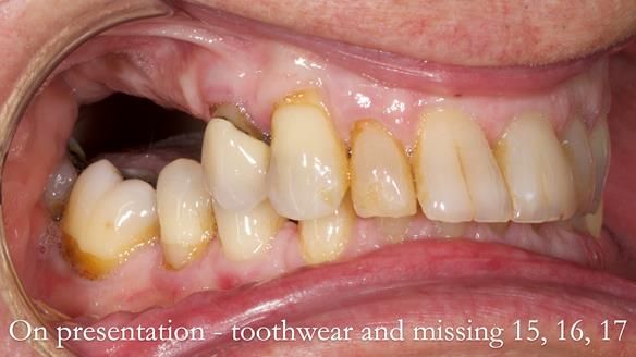 Finlay's Newsletter 64 case study - provision of a Kennedy class 2 metal based Scandinavian RPD for Ian