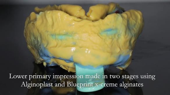 Finlay's Newsletter 61 provision of a lower unilateral free end saddle metal based partial denture for Joyce