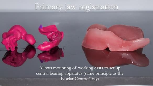 Newsletter 54 case presentation upper complete denture and lower Scandinavian designed hygienic partial denture for David