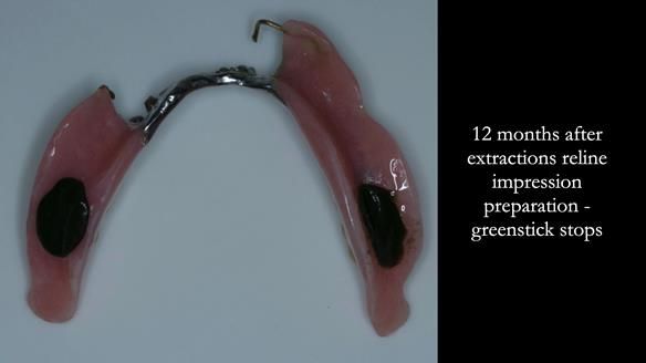 Ken – going downhill, first class