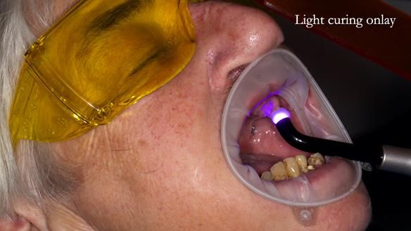 Newsletter 55 Provision of metal based partial dentures for Zephyrine with a repaired cleft lip and palate