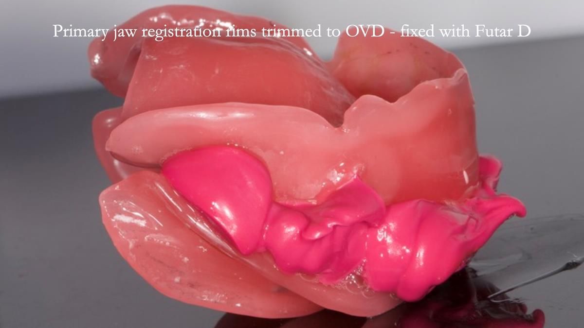 Fin’s Newsletter 88 — Complete dentures - full protocol… he rearranged his own teeth!