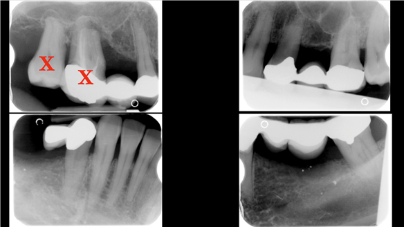 Figure 8 Radiograph - hopeless teeth 17, 16