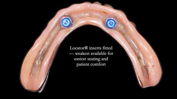 Newsletter 78: What do Clark Gable and a Locator® overdenture have in common?