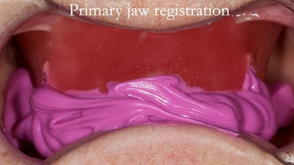 Newsletter 75: Marion’s case - Step-by-step complete denture workflow