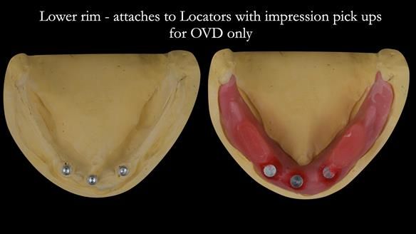 Lower pivot/rim which attaches to the implants for treatment visit 3