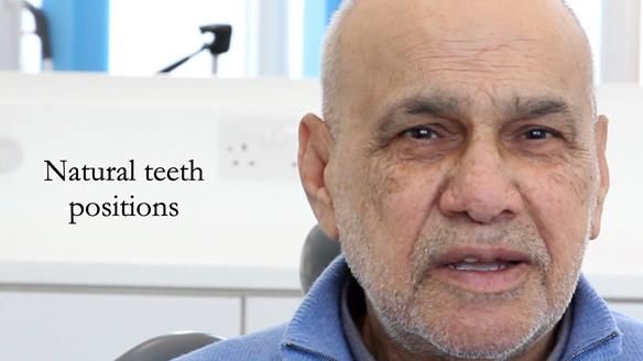 Managing poor implant positioning with complete dentures and Locator attachments - full protocol Newsletter 41