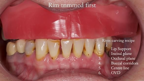 Newsletter 52 Managing Jo’s failing dentition with extractions and Mk 1/Mk 2 complete upper dentures and lower partial dentures FULL PROTOCOL
