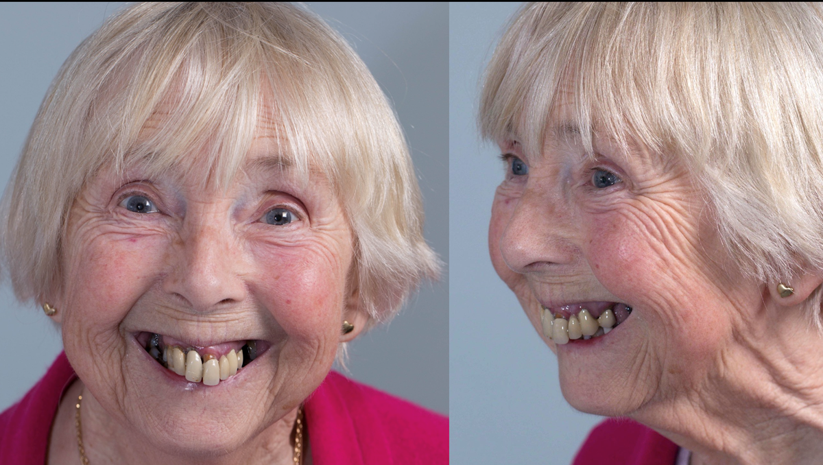 Figure 1 Pre - treatment. High smile line and failing upper teeth.