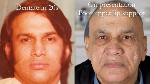 Managing poor implant positioning with complete dentures and Locator attachments - full protocol Newsletter 41