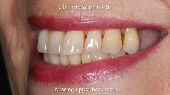 Newsletter 56 showing the making and fitting of a bilateral free end saddle upper removable partial denture (RPD) for patient with pemphigus