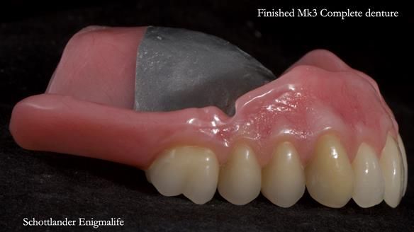 Newsletter 77: Jeremy’s case – immediate complete upper denture