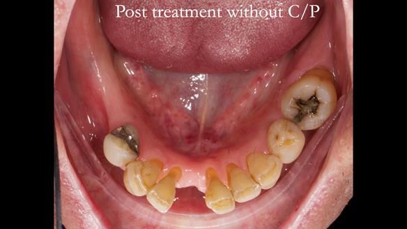 Newsletter 54 case presentation upper complete denture and lower Scandinavian designed hygienic partial denture for David