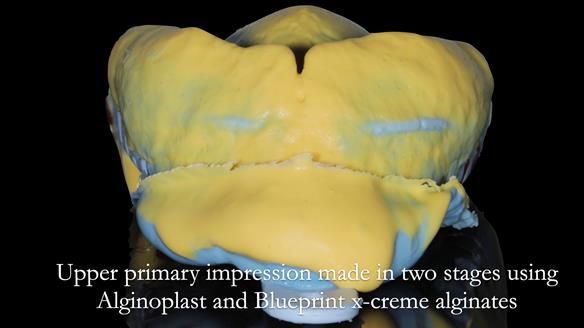 Newsletter 56 showing the making and fitting of a bilateral free end saddle upper removable partial denture (RPD) for patient with pemphigus