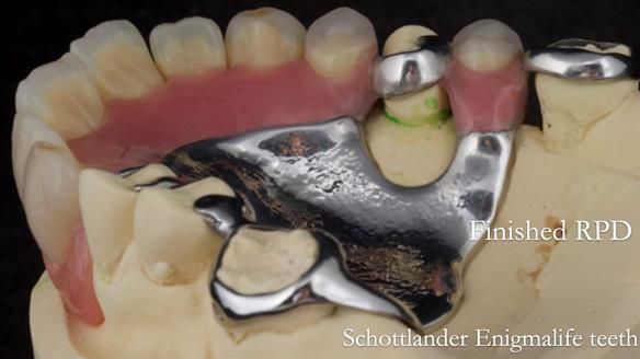 Eileen's transformation with upper and lower RPDs of Scandinavian hygienic design FULL PROTOCOL