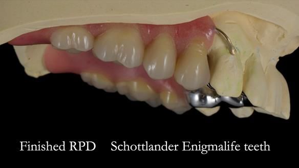 Newsletter 56 showing the making and fitting of a bilateral free end saddle upper removable partial denture (RPD) for patient with pemphigus