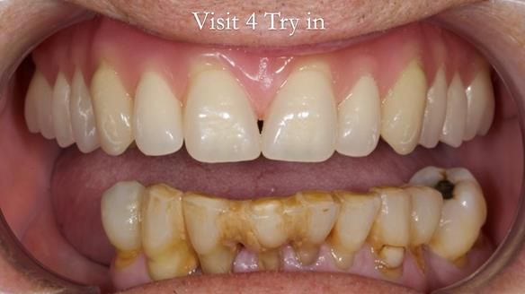 Newsletter 54 case presentation upper complete denture and lower Scandinavian designed hygienic partial denture for David