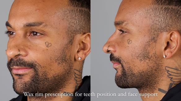 Upper metal base partial denture/occlusal stabilisation splint/obturator - full protocol