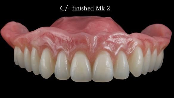 Newsletter 52 Managing Jo’s failing dentition with extractions and Mk 1/Mk 2 complete upper dentures and lower partial dentures FULL PROTOCOL