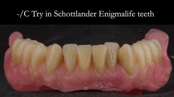 Complete denture Class II div 2 deep overbite Newsletter 39