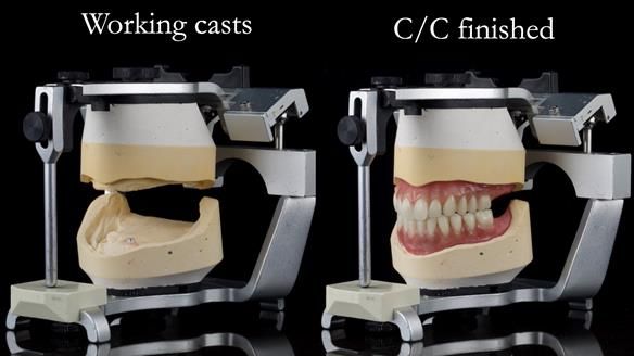 Managing poor implant positioning with complete dentures and Locator attachments - full protocol Newsletter 41