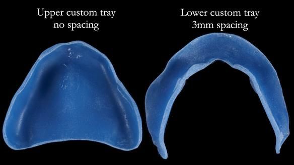 Newsletter 80 - Gordon’s dentures: the one case in 1,000 where my technique failed