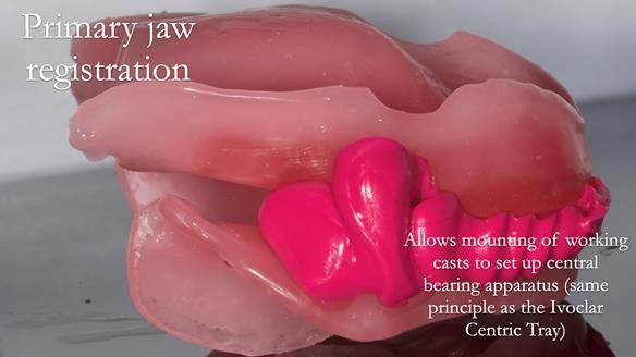 Newsletter 53 showing the making and fitting of ultra life-like dentures for Valena