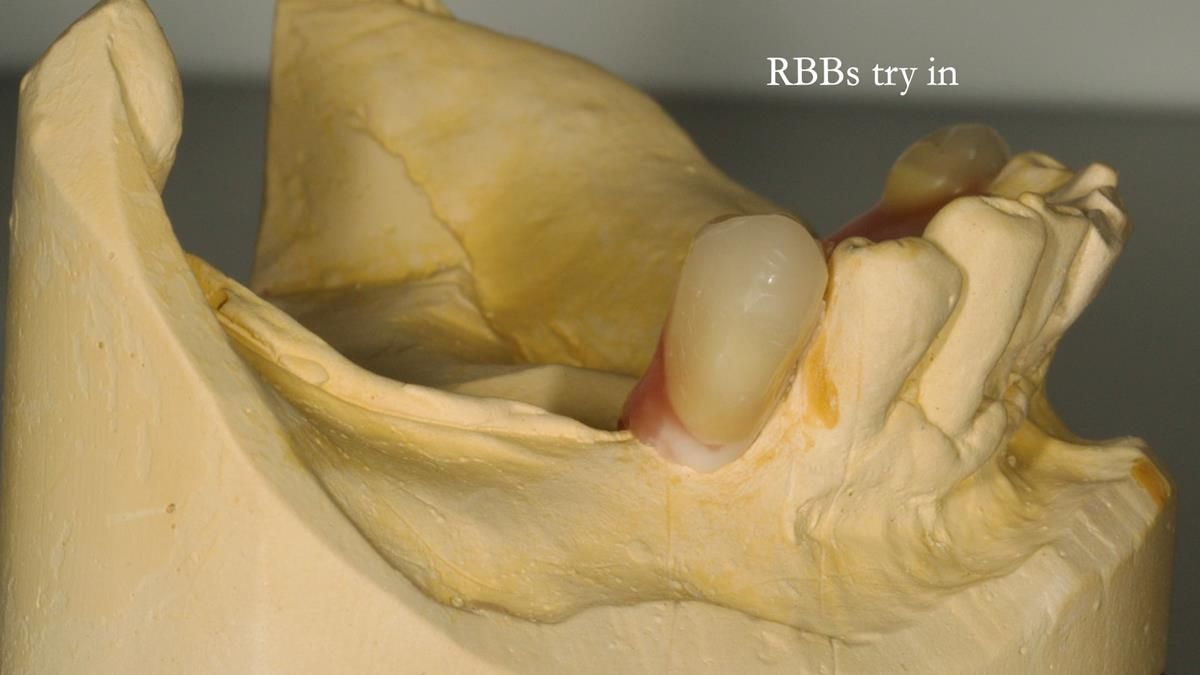 Newsletter 87 – Father Peter: A Partial Denture that needed Minor Miracle