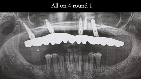 Solving Linda’s Failed “All on 4” implant bridges - full protocol Newsletter 42