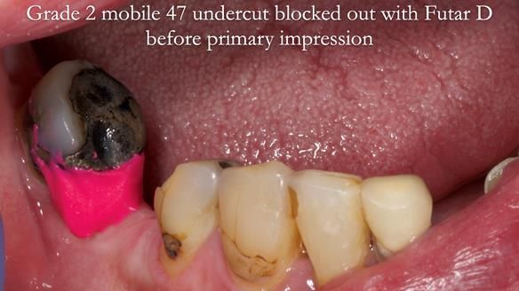 Newsletter 55 Provision of metal based partial dentures for Zephyrine with a repaired cleft lip and palate